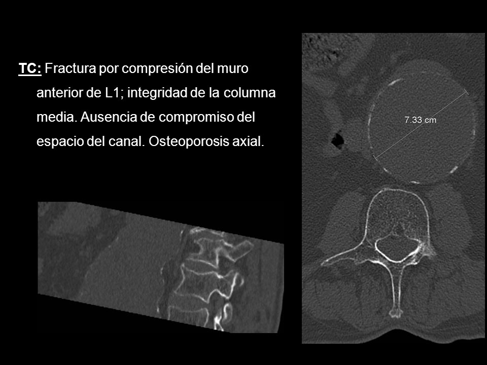 TC: Fractura por compresión del muro anterior de L1; integridad de la columna media.