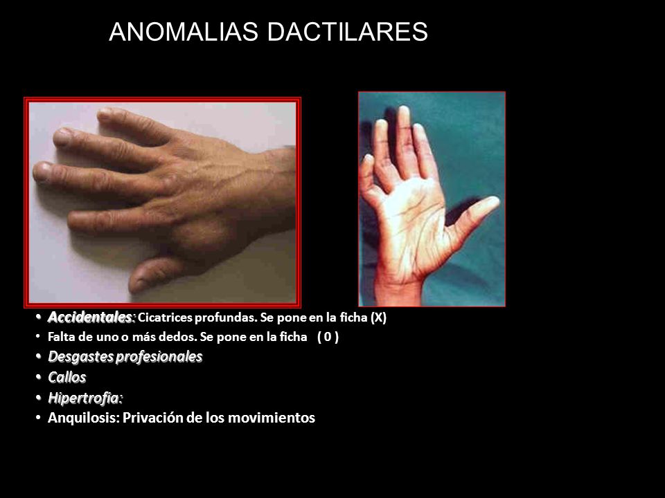 ANOMALIAS DACTILARES Accidentales: Cicatrices profundas. Se pone en la ficha (X) Falta de uno o más dedos. Se pone en la ficha ( 0 )