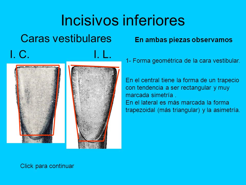Caras vestibulares En ambas piezas observamos I. C. I. L.