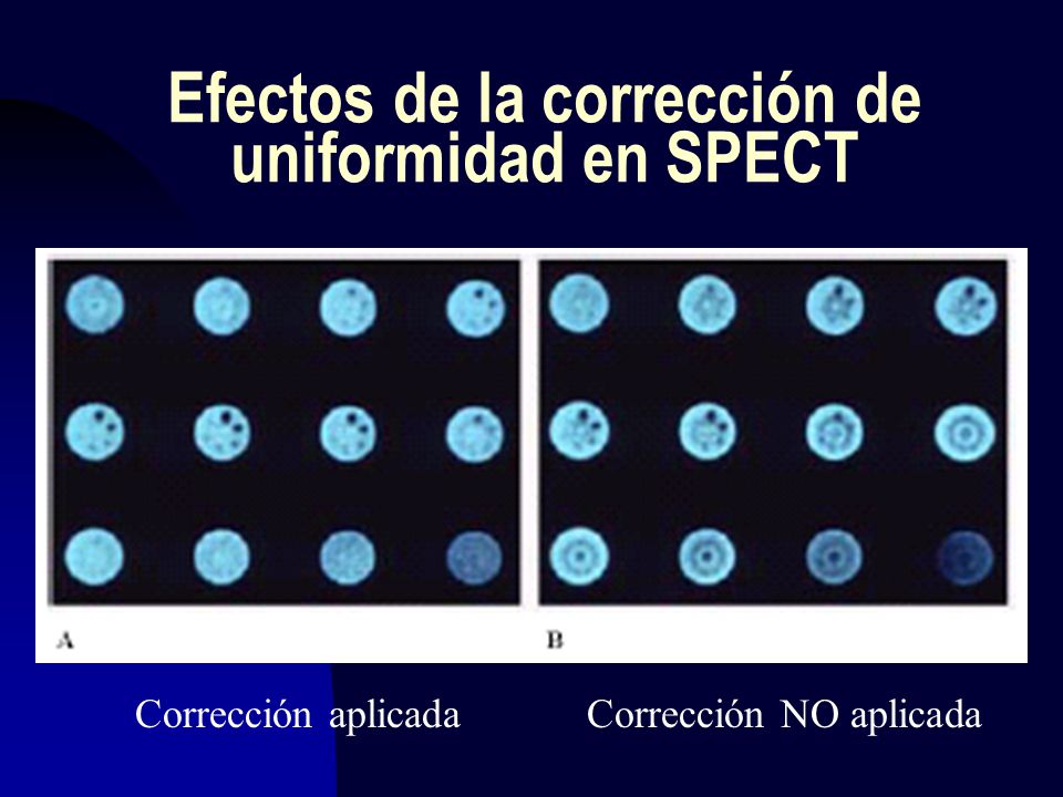 Efectos de la corrección de uniformidad en SPECT