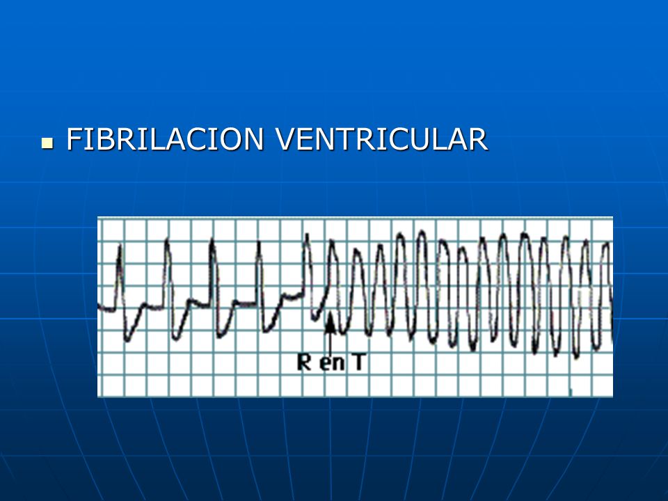 FIBRILACION VENTRICULAR