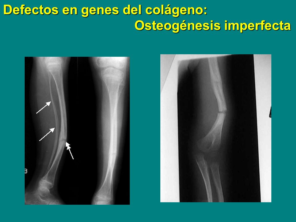 Defectos en genes del colágeno: