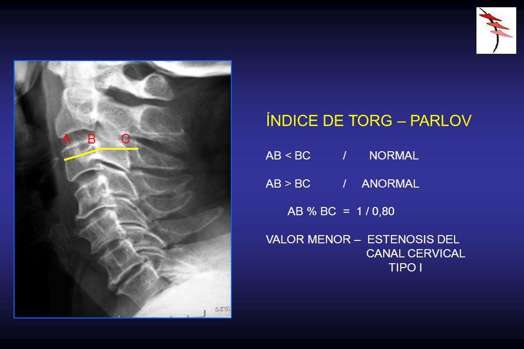 ÍNDICE DE TORG – PARLOV A B C AB < BC / NORMAL AB > BC / ANORMAL