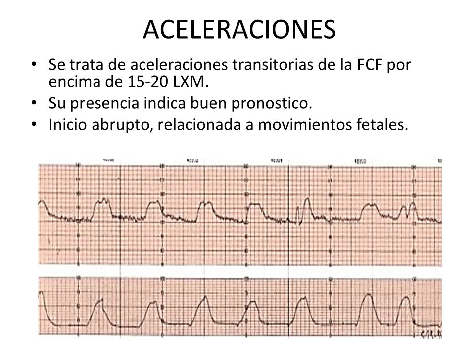 ACELERACIONES Se trata de aceleraciones transitorias de la FCF por encima de LXM. Su presencia indica buen pronostico.