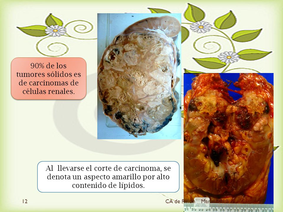 90% de los tumores sólidos es de carcinomas de células renales.