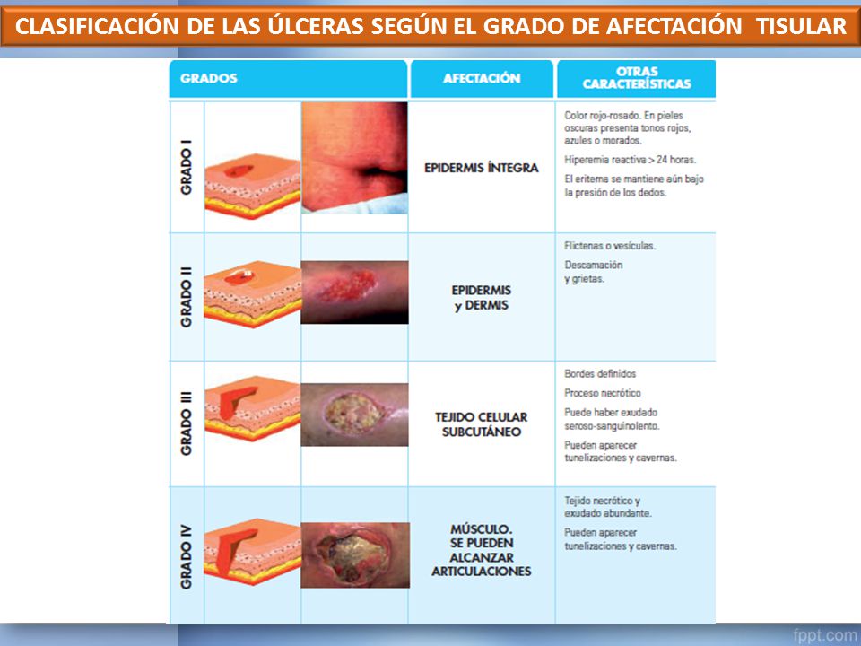 CLASIFICACIÓN DE LAS ÚLCERAS SEGÚN EL GRADO DE AFECTACIÓN TISULAR