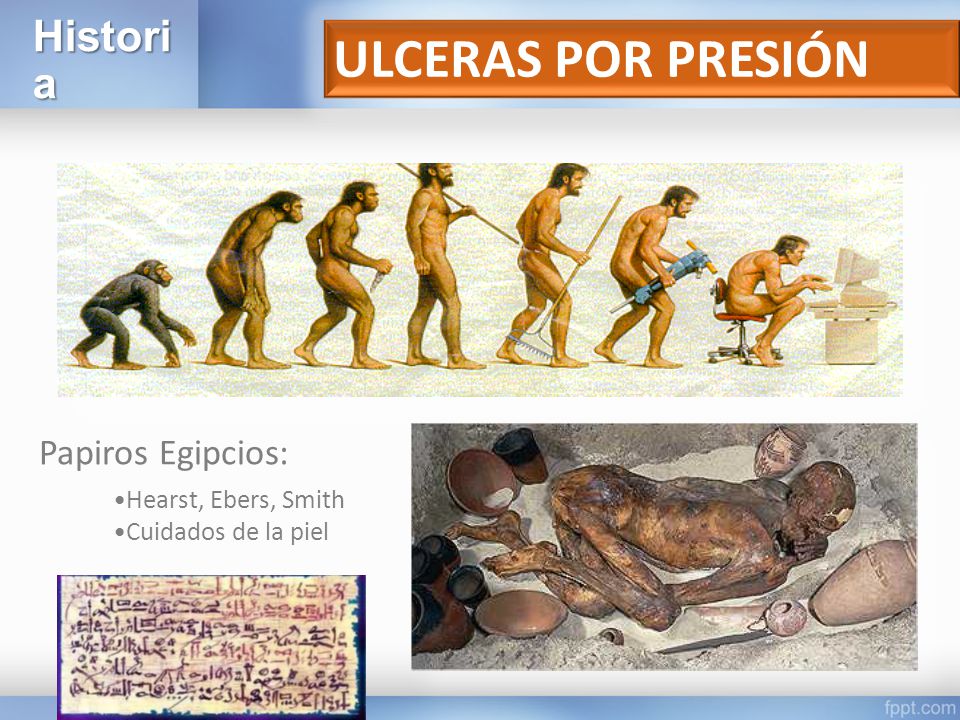 ULCERAS POR PRESIÓN Historia Papiros Egipcios: •Hearst, Ebers, Smith