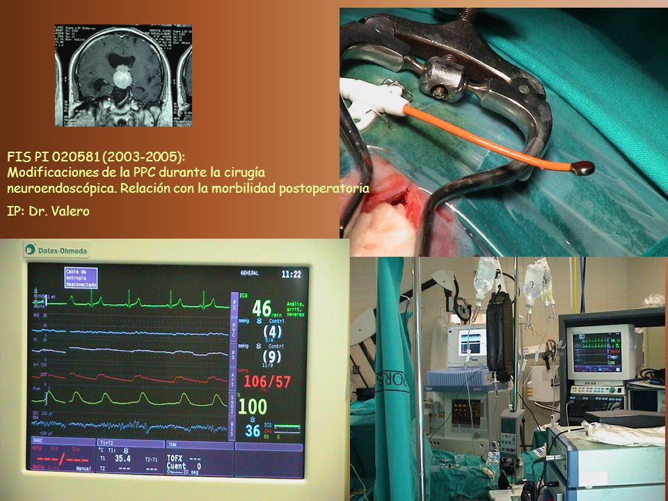 FIS PI ( ): Modificaciones de la PPC durante la cirugía neuroendoscópica. Relación con la morbilidad postoperatoria