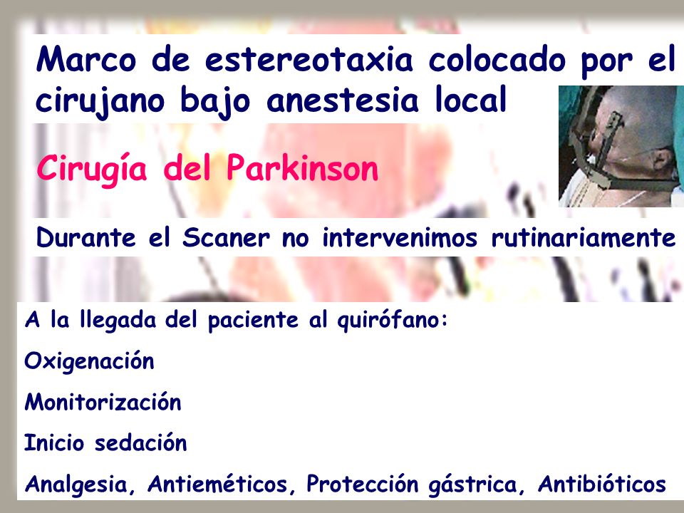 Marco de estereotaxia colocado por el cirujano bajo anestesia local