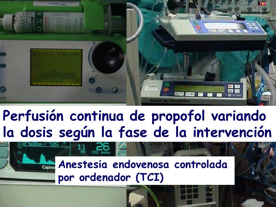 Perfusión continua de propofol variando la dosis según la fase de la intervención