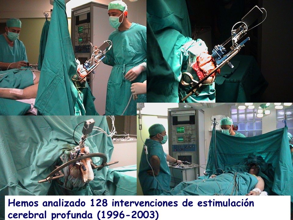 Hemos analizado 128 intervenciones de estimulación cerebral profunda ( )