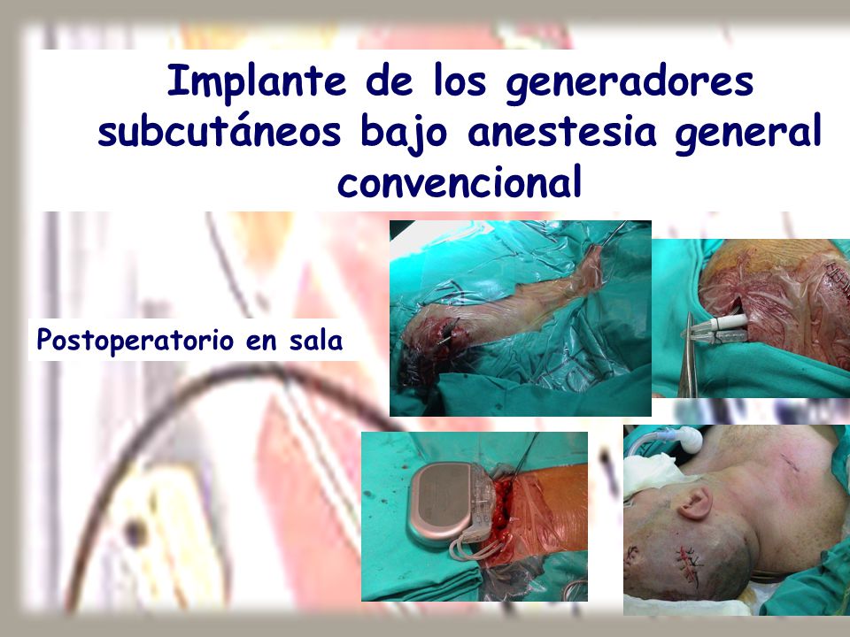 Implante de los generadores subcutáneos bajo anestesia general convencional