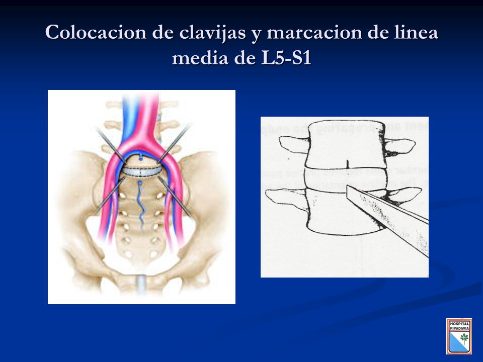 Colocacion de clavijas y marcacion de linea media de L5-S1