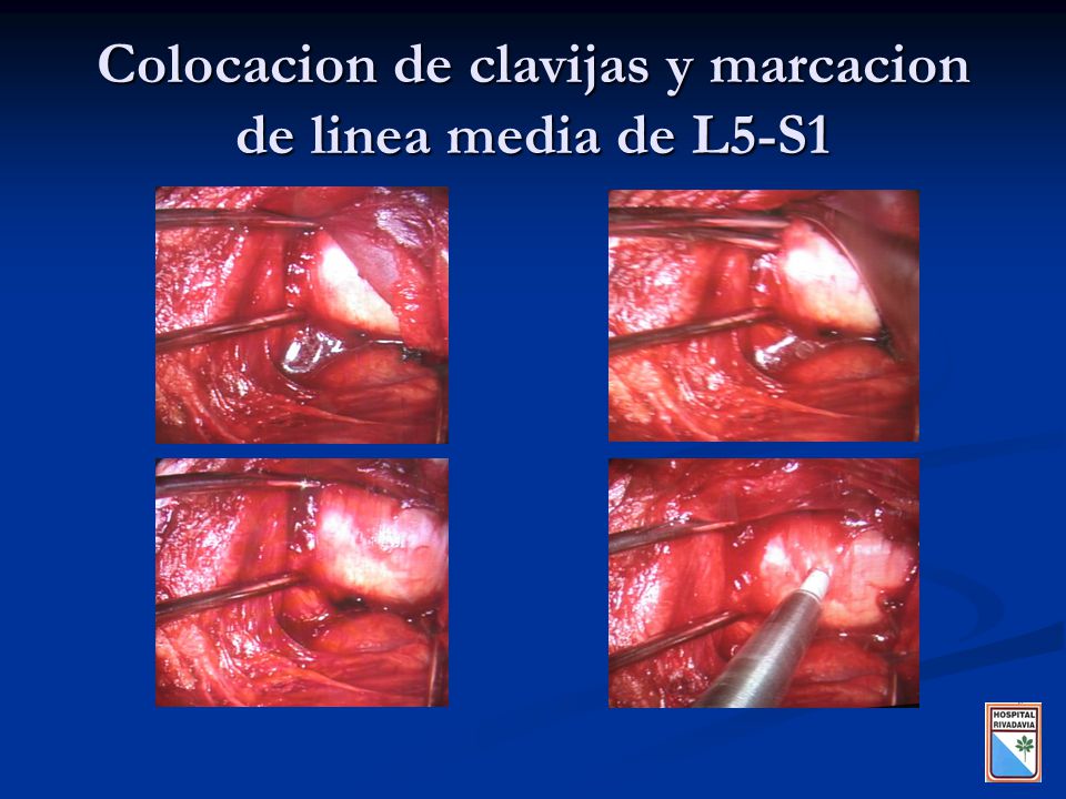 Colocacion de clavijas y marcacion de linea media de L5-S1