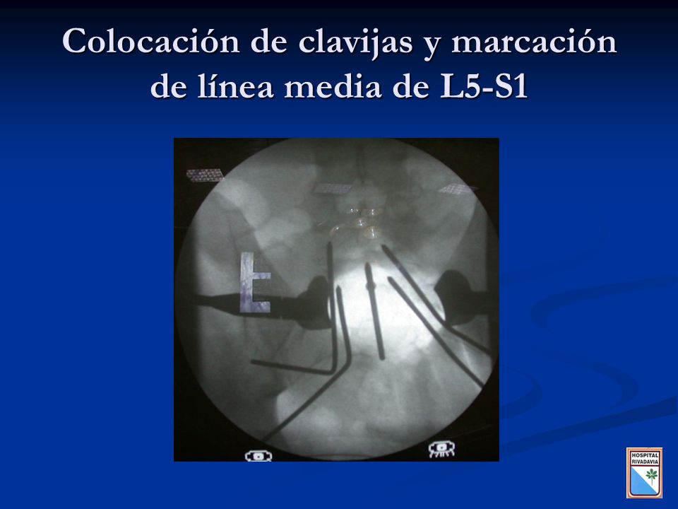 Colocación de clavijas y marcación de línea media de L5-S1