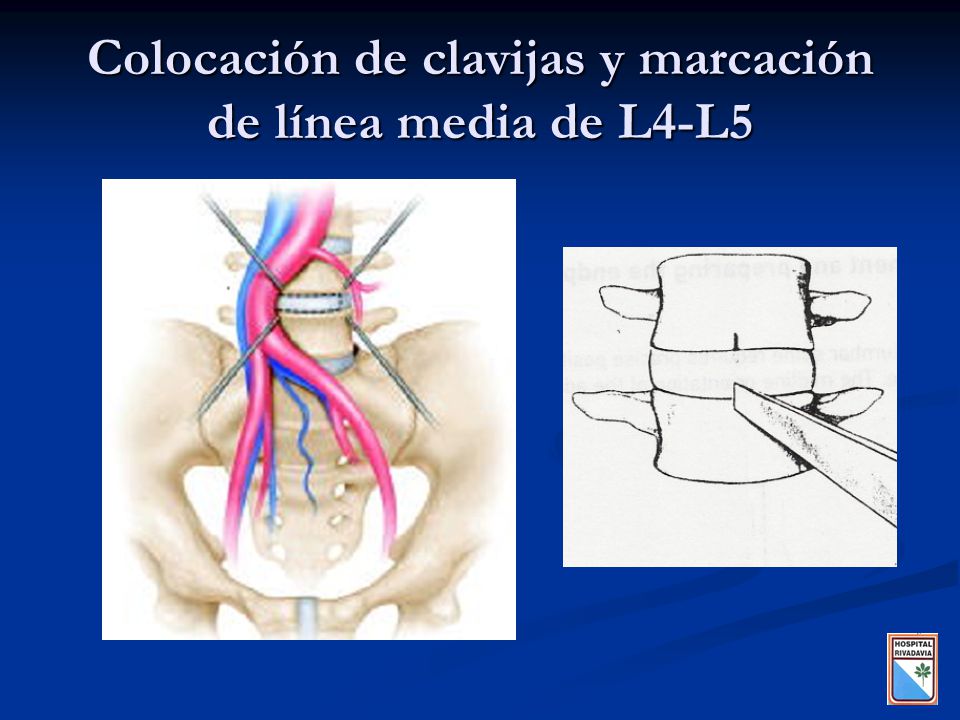 Colocación de clavijas y marcación de línea media de L4-L5