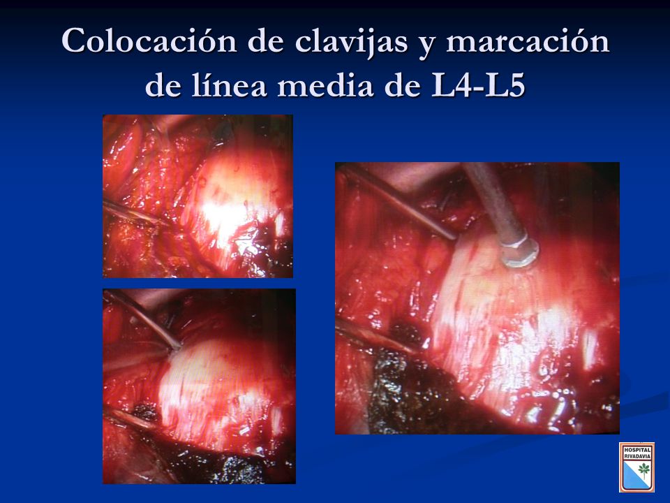 Colocación de clavijas y marcación de línea media de L4-L5