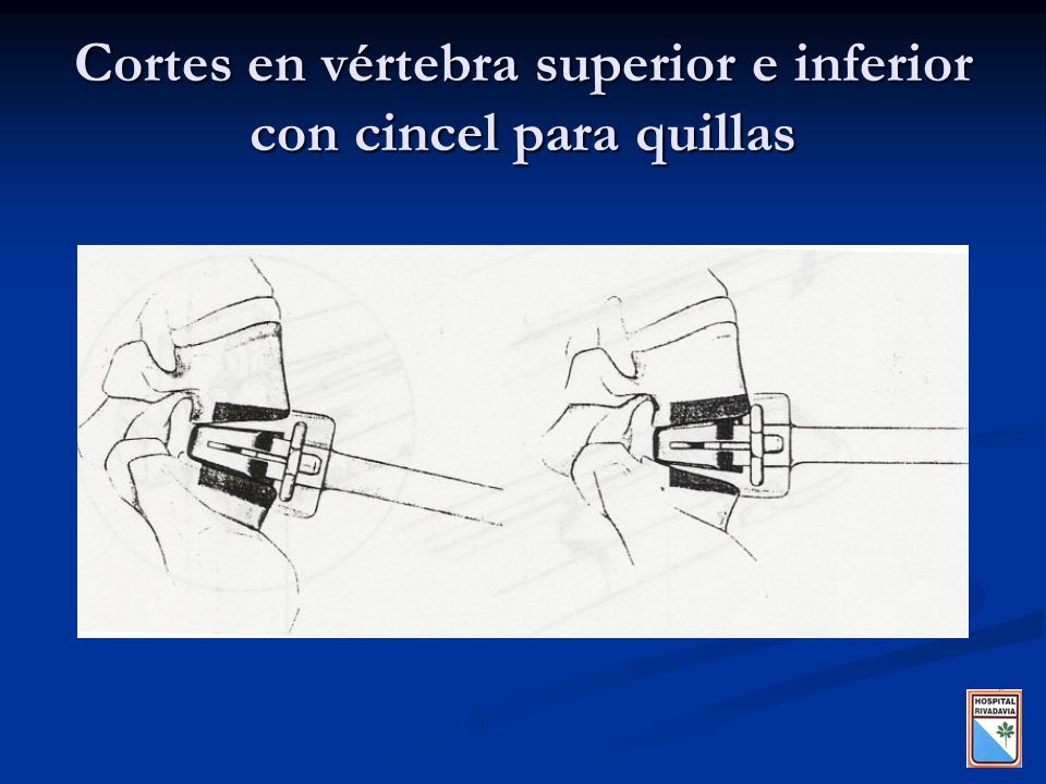 Cortes en vértebra superior e inferior con cincel para quillas