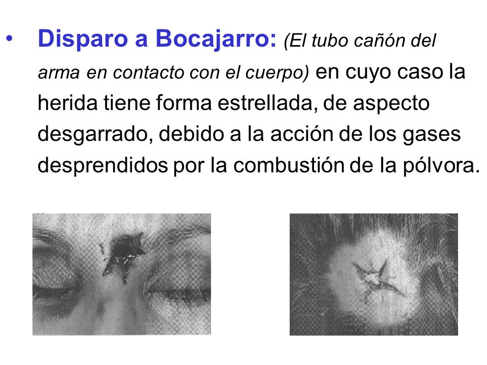 Disparo a Bocajarro: (El tubo cañón del arma en contacto con el cuerpo) en cuyo caso la herida tiene forma estrellada, de aspecto desgarrado, debido a la acción de los gases desprendidos por la combustión de la pólvora.