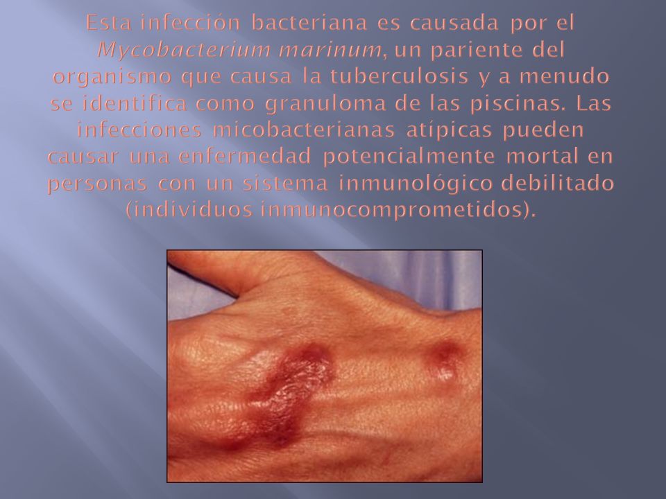 Esta infección bacteriana es causada por el Mycobacterium marinum, un pariente del organismo que causa la tuberculosis y a menudo se identifica como granuloma de las piscinas.