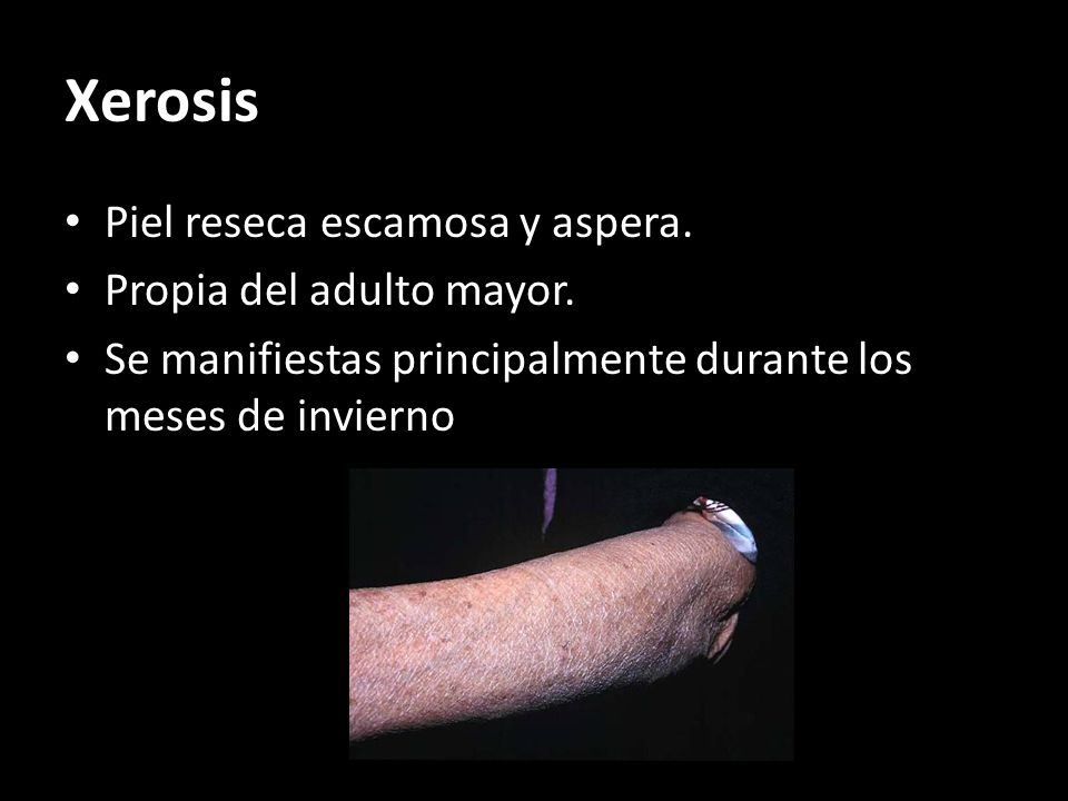 Xerosis Piel reseca escamosa y aspera. Propia del adulto mayor.