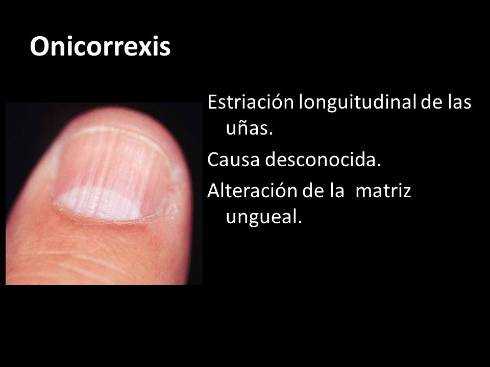 Onicorrexis Estriación longuitudinal de las uñas. Causa desconocida.