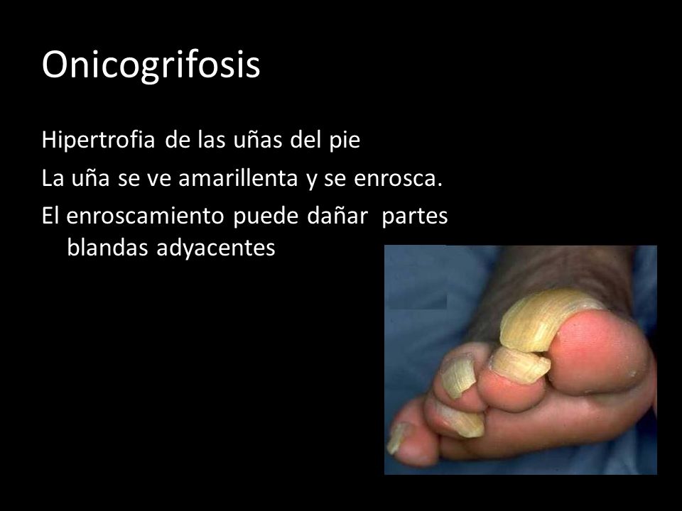 Onicogrifosis Hipertrofia de las uñas del pie La uña se ve amarillenta y se enrosca.