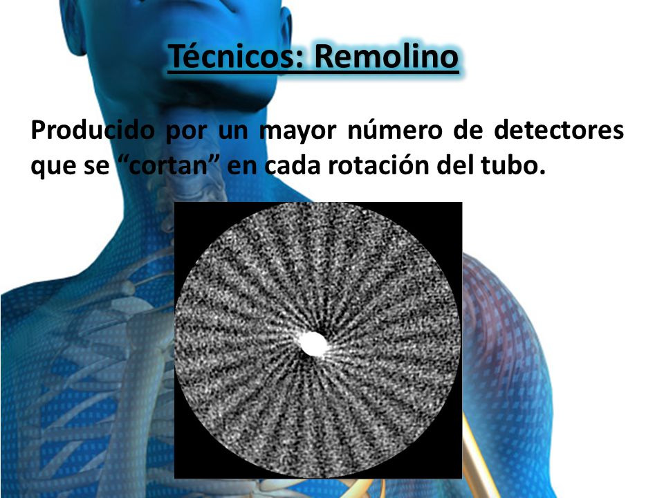 Técnicos: Remolino Producido por un mayor número de detectores que se cortan en cada rotación del tubo.