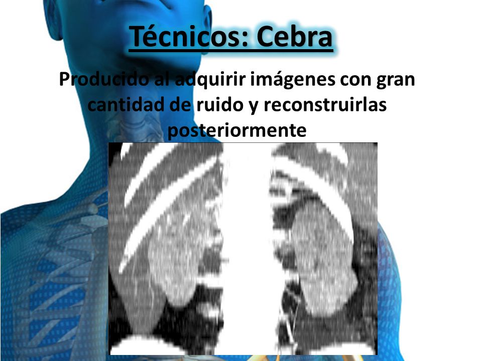 Técnicos: Cebra Producido al adquirir imágenes con gran cantidad de ruido y reconstruirlas posteriormente.