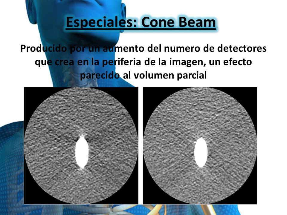 Especiales: Cone Beam Producido por un aumento del numero de detectores que crea en la periferia de la imagen, un efecto parecido al volumen parcial.