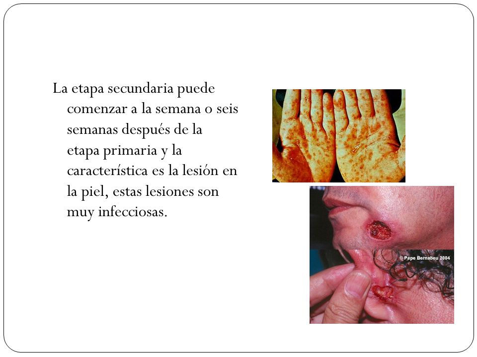 La etapa secundaria puede comenzar a la semana o seis semanas después de la etapa primaria y la característica es la lesión en la piel, estas lesiones son muy infecciosas.
