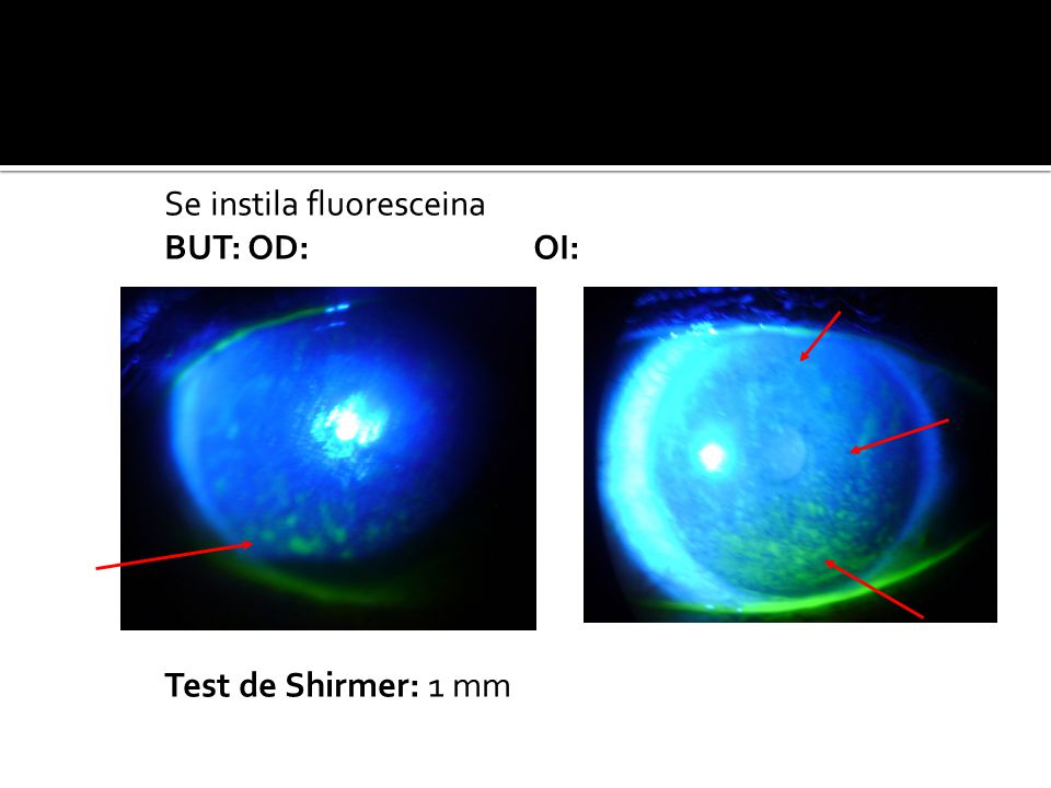 Se instila fluoresceina BUT: OD: OI: Test de Schirmer I: 1mm Test de Shirmer: 1 mm