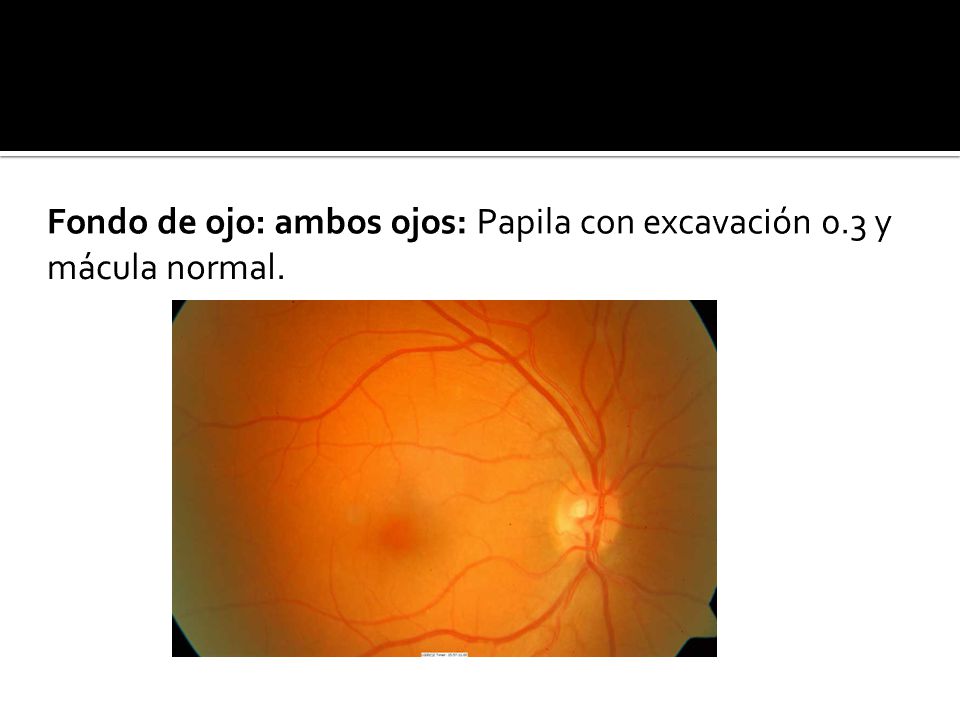 Fondo de ojo: ambos ojos: Papila con excavación 0.3 y mácula normal.