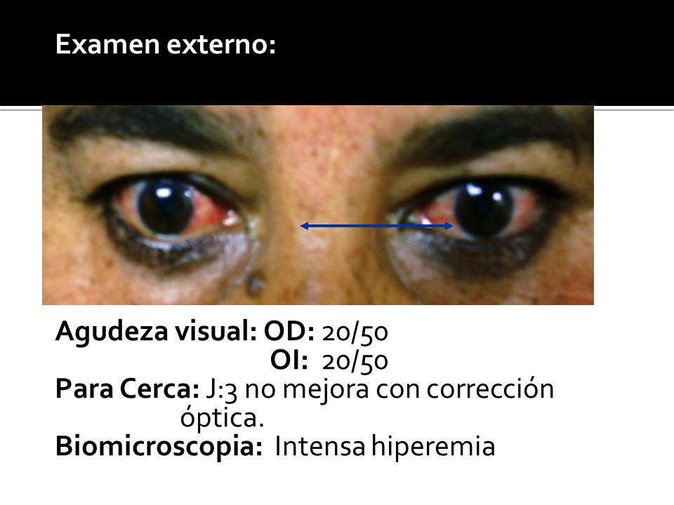 Examen externo: Agudeza visual: OD: 20/50. OI: 20/50. Para Cerca: J:3 no mejora con corrección. óptica.