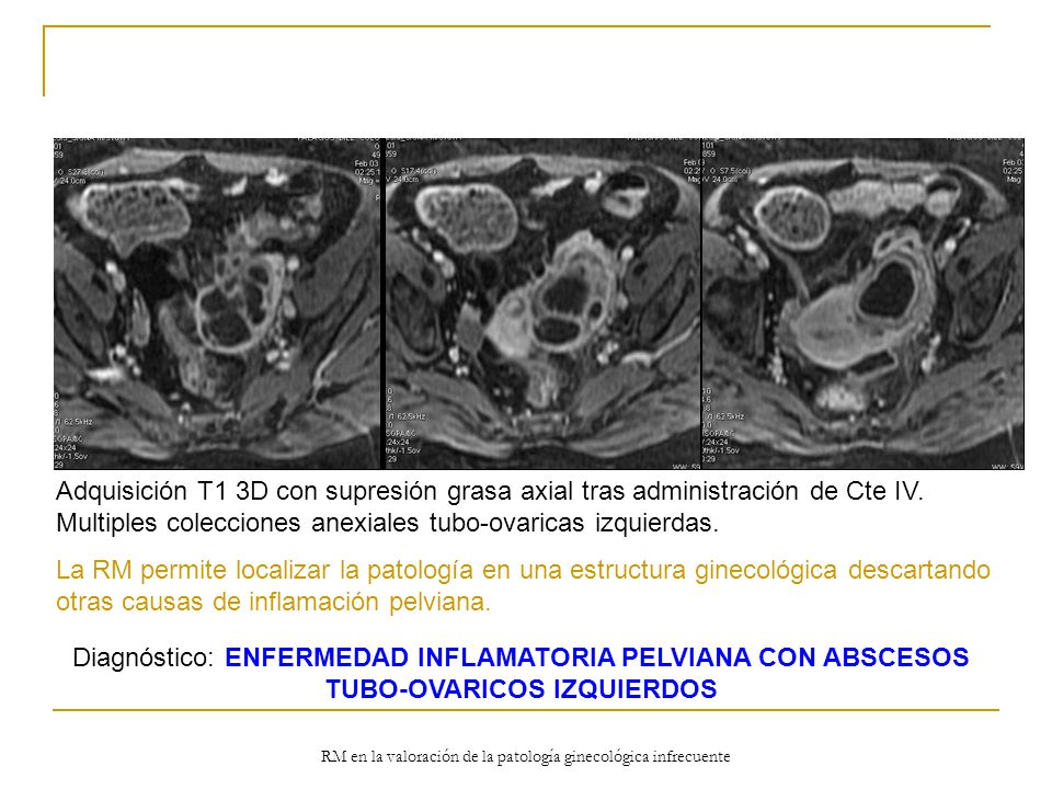 RM en la valoración de la patología ginecológica infrecuente