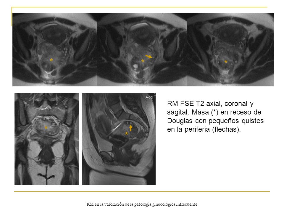 RM en la valoración de la patología ginecológica infrecuente