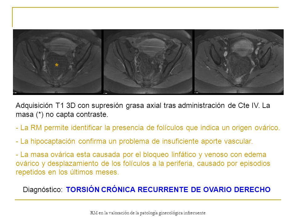 * Adquisición T1 3D con supresión grasa axial tras administración de Cte IV. La masa (*) no capta contraste.