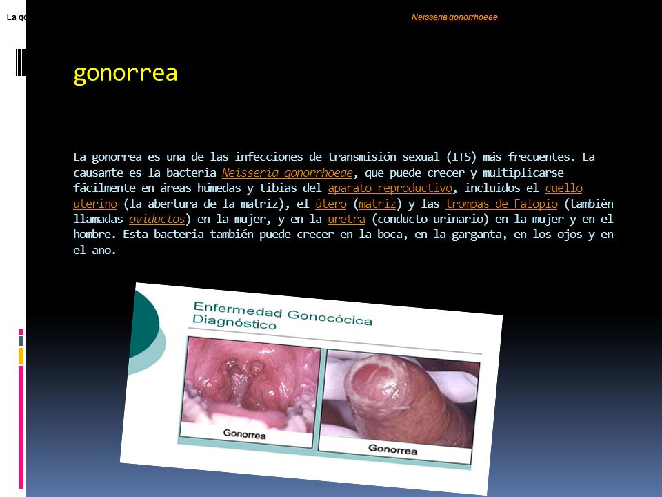 La gonorrea es una de las infecciones de transmisión sexual (ITS) más frecuentes. La causante es la bacteria Neisseria gonorrhoeae, que puede crecer y multiplicarse fácilmente en áreas húmedas y tibias del aparato reproductivo, incluidos el cuello uterino (la abertura de la matriz), el útero (matriz) y las trompas de Falopio (también llamadas oviductos) en la mujer, y en la uretra (conducto urinario) en la mujer y en el hombre. Esta bacteria también puede crecer en la boca, en la garganta, en los ojos y en el ano.