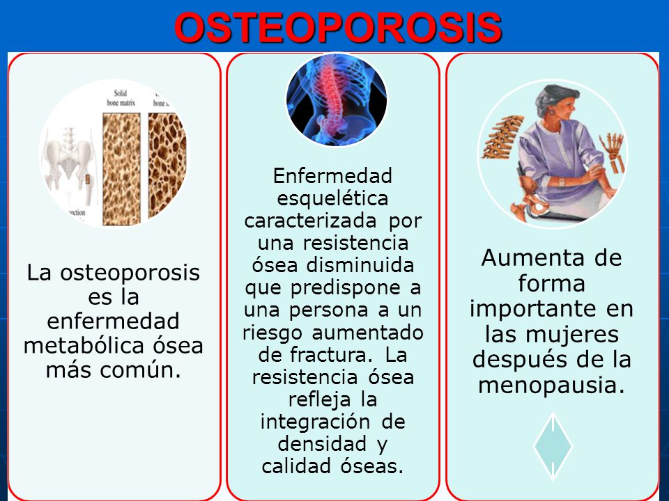 OSTEOPOROSIS La osteoporosis es la enfermedad metabólica ósea más común.