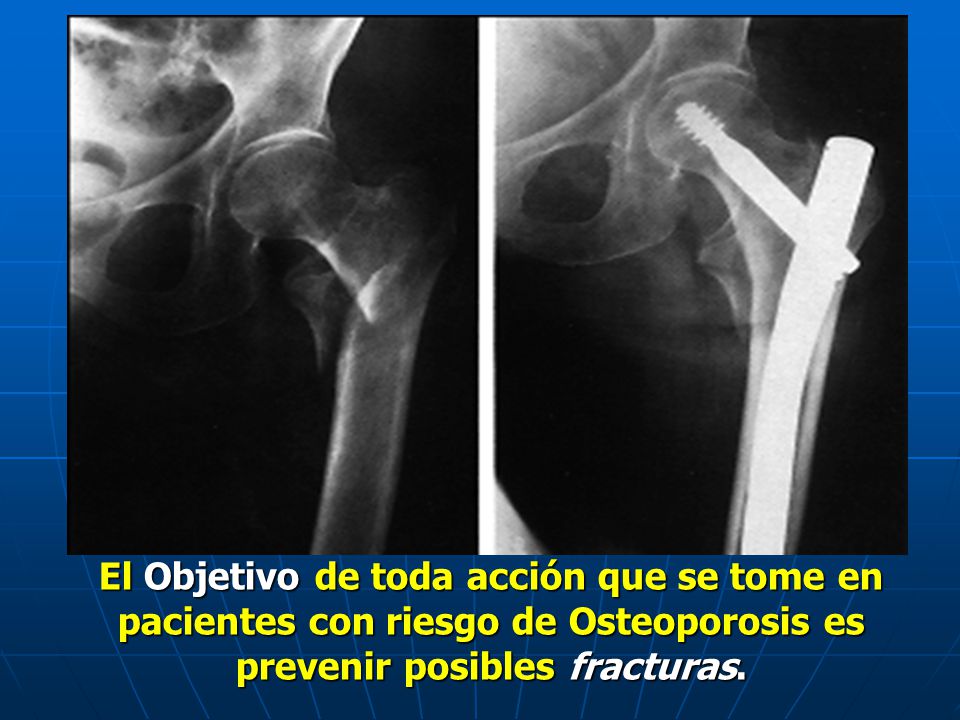 El Objetivo de toda acción que se tome en pacientes con riesgo de Osteoporosis es prevenir posibles fracturas.