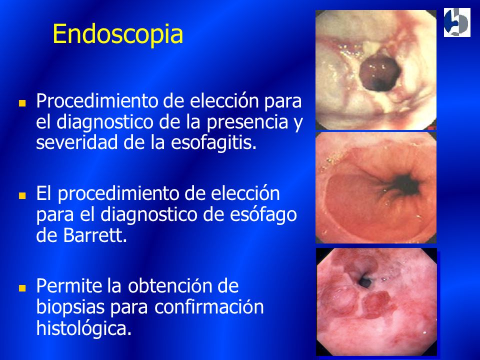 Endoscopia Procedimiento de elección para el diagnostico de la presencia y severidad de la esofagitis.