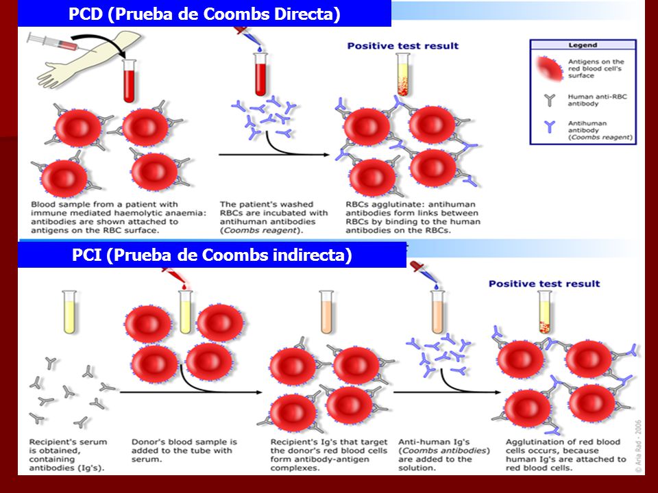PCD (Prueba de Coombs Directa) PCI (Prueba de Coombs indirecta)