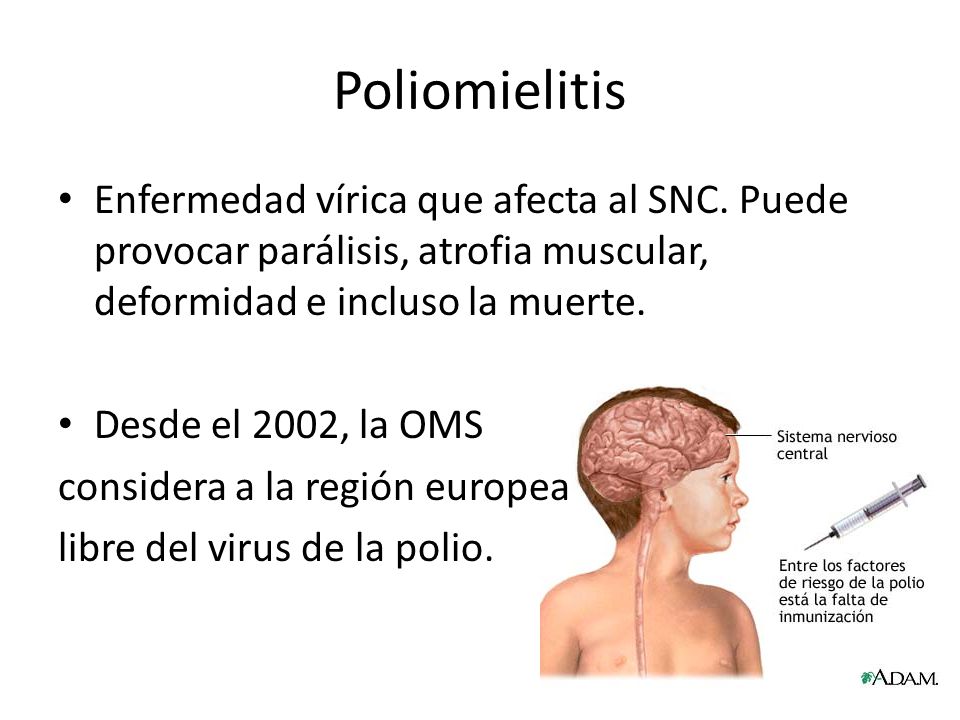 Poliomielitis Enfermedad vírica que afecta al SNC. Puede provocar parálisis, atrofia muscular, deformidad e incluso la muerte.