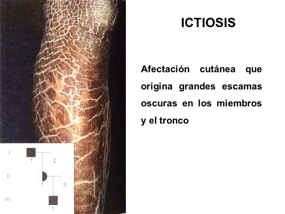 ICTIOSIS Afectación cutánea que origina grandes escamas oscuras en los miembros y el tronco