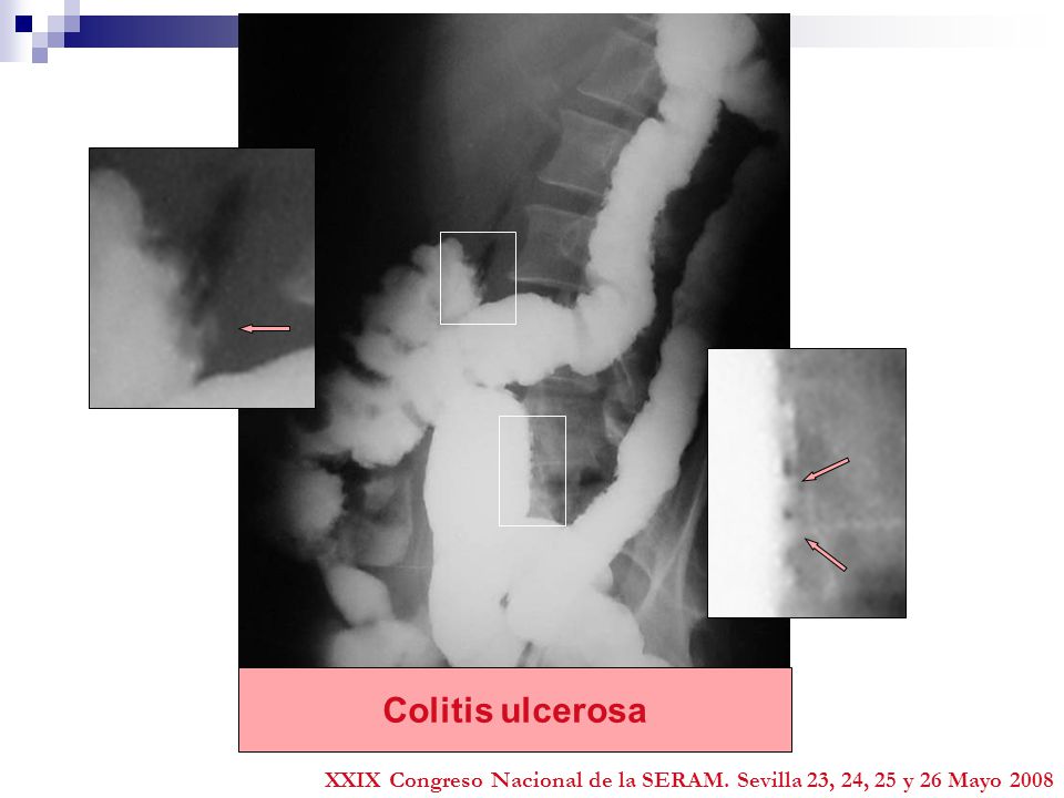 Colitis ulcerosa XXIX Congreso Nacional de la SERAM. Sevilla 23, 24, 25 y 26 Mayo 2008