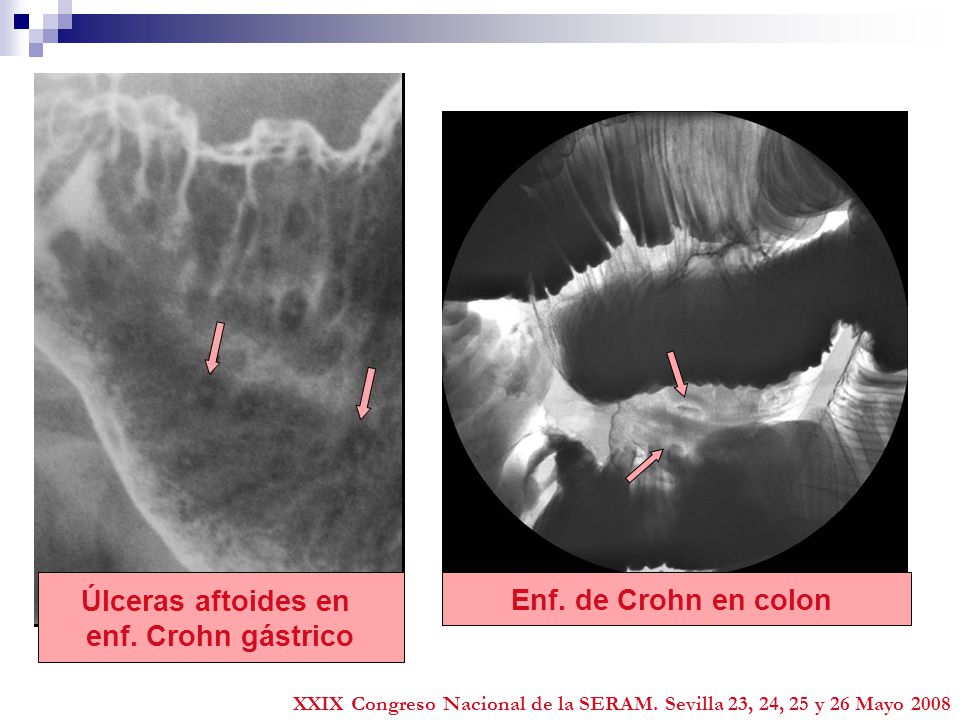 Úlceras aftoides en enf. Crohn gástrico Enf. de Crohn en colon