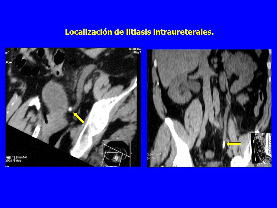 Localización de litiasis intraureterales.
