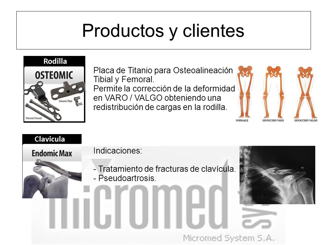Productos y clientes Placa de Titanio para Osteoalineación Tibial y Femoral.