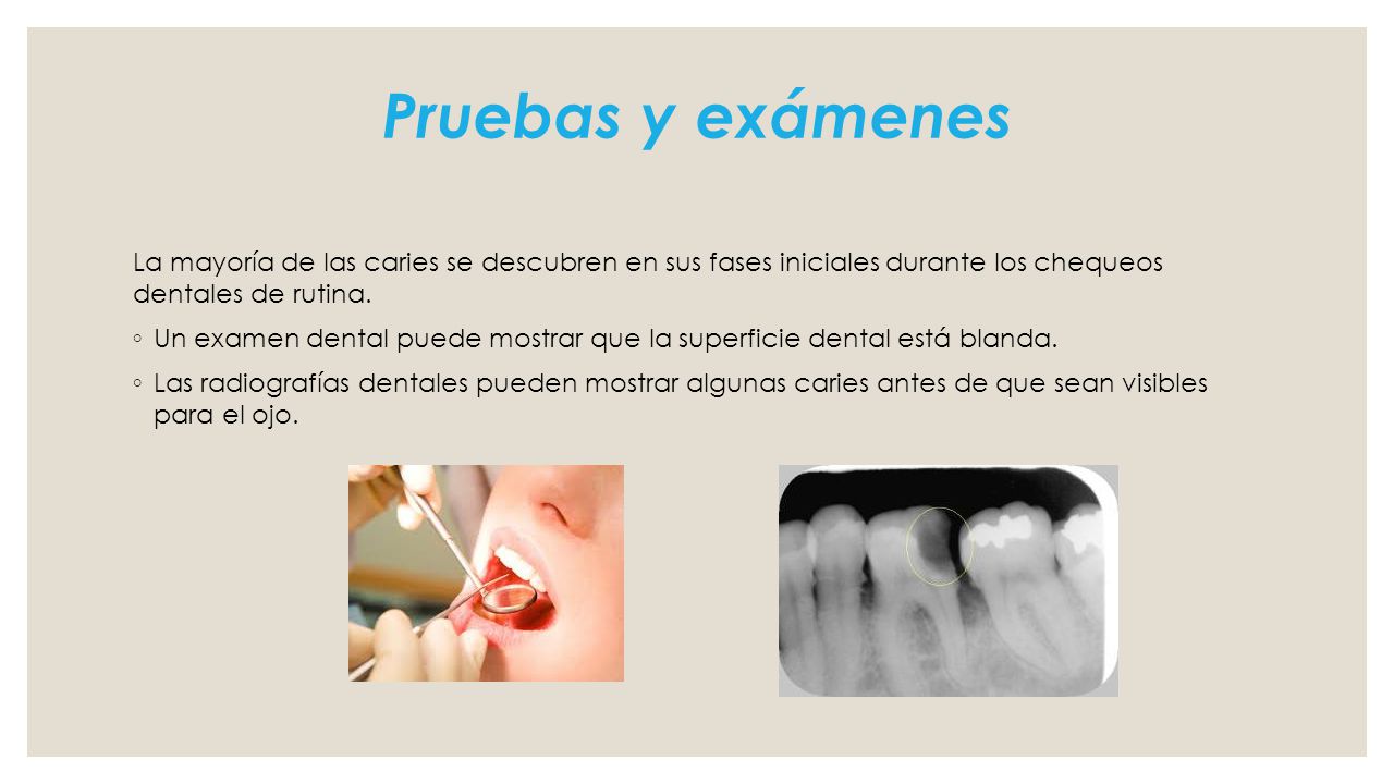 Pruebas y exámenes La mayoría de las caries se descubren en sus fases iniciales durante los chequeos dentales de rutina.