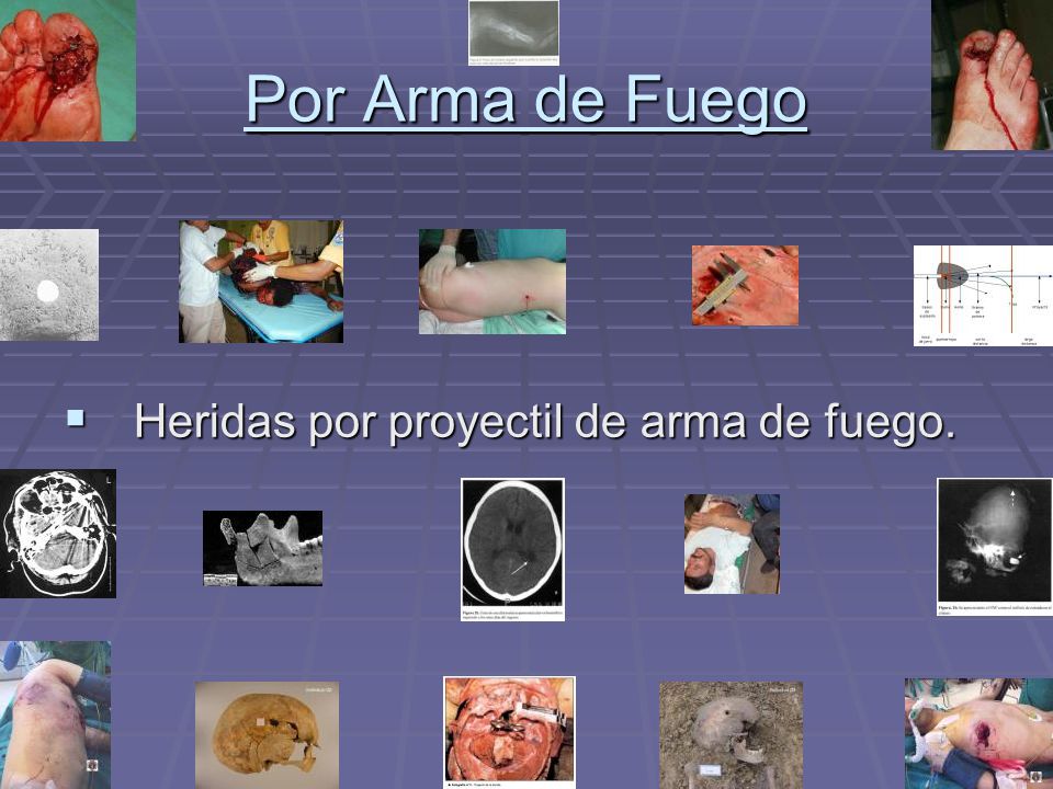 Por Arma de Fuego Heridas por proyectil de arma de fuego.